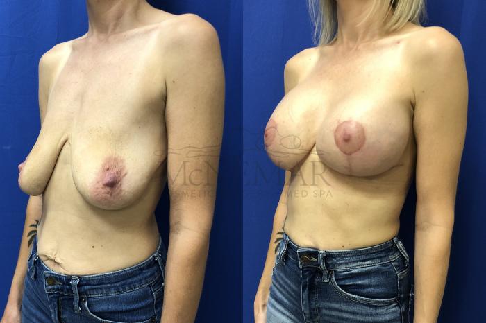 Breast Lift (Mastopexy) Case 156 Before & After Right Side | Tracy, Brentwood & Livermore, CA | McNemar Cosmetic Surgery