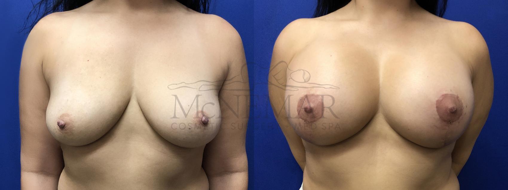 Breast Augmentation Case 181 Before & After Back | Tracy, Brentwood & Livermore, CA | McNemar Cosmetic Surgery