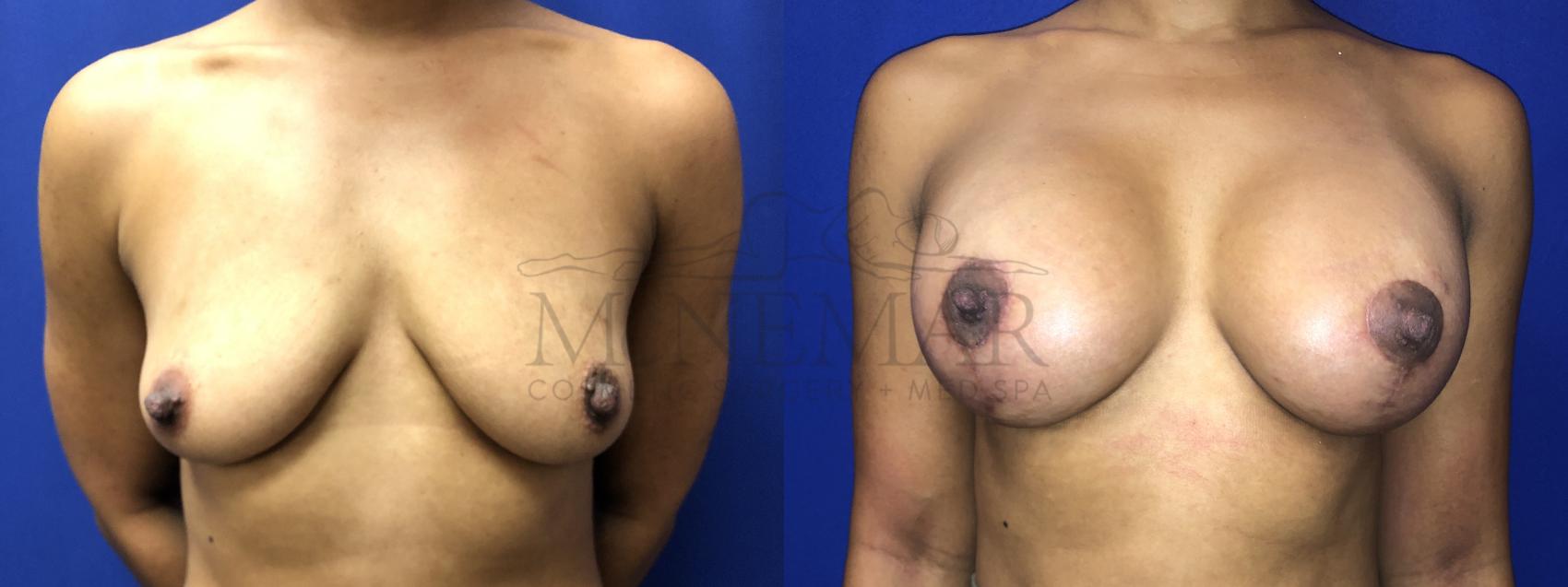 Breast Lift (Mastopexy) Case 186 Before & After Front | Tracy, Brentwood & Livermore, CA | McNemar Cosmetic Surgery