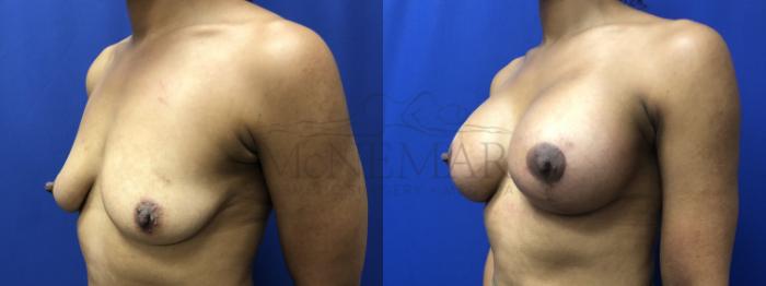 Breast Lift (Mastopexy) Case 186 Before & After Left Side | Tracy, Brentwood & Livermore, CA | McNemar Cosmetic Surgery