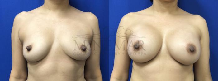 Breast Augmentation Case 189 Before & After Front | Tracy, Brentwood & Livermore, CA | McNemar Cosmetic Surgery