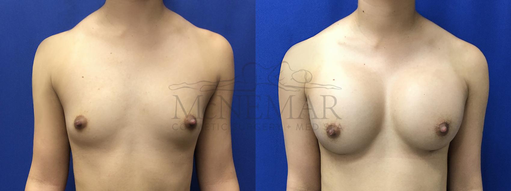 Breast Augmentation Case 190 Before & After Front | Tracy, Brentwood & Livermore, CA | McNemar Cosmetic Surgery