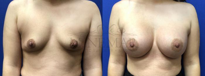 Breast Augmentation Case 193 Before & After Front | Tracy, Brentwood & Livermore, CA | McNemar Cosmetic Surgery