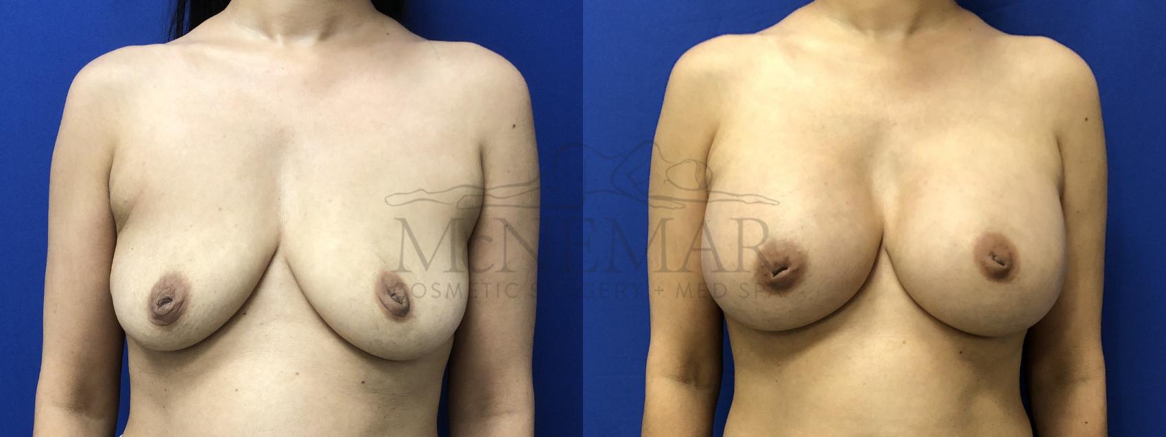 Breast Augmentation Case 194 Before & After Front | Tracy, Brentwood & Livermore, CA | McNemar Cosmetic Surgery