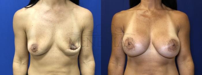 Breast Augmentation Case 195 Before & After Front | Tracy, Brentwood & Livermore, CA | McNemar Cosmetic Surgery