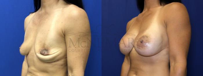 Breast Augmentation Case 195 Before & After Left Side | Tracy, Brentwood & Livermore, CA | McNemar Cosmetic Surgery