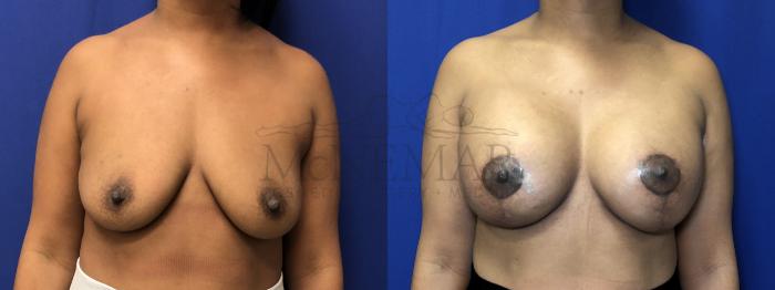 Breast Augmentation Case 206 Before & After Front | Tracy, Brentwood & Livermore, CA | McNemar Cosmetic Surgery