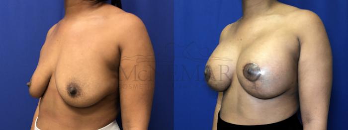 Breast Augmentation Case 206 Before & After Left Side | Tracy, Brentwood & Livermore, CA | McNemar Cosmetic Surgery