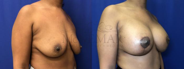 Breast Augmentation Case 206 Before & After Right Side | Tracy, Brentwood & Livermore, CA | McNemar Cosmetic Surgery