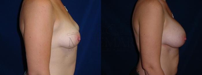 Breast Augmentation Case 27 Before & After View #1 | Tracy, Brentwood & Livermore, CA | McNemar Cosmetic Surgery