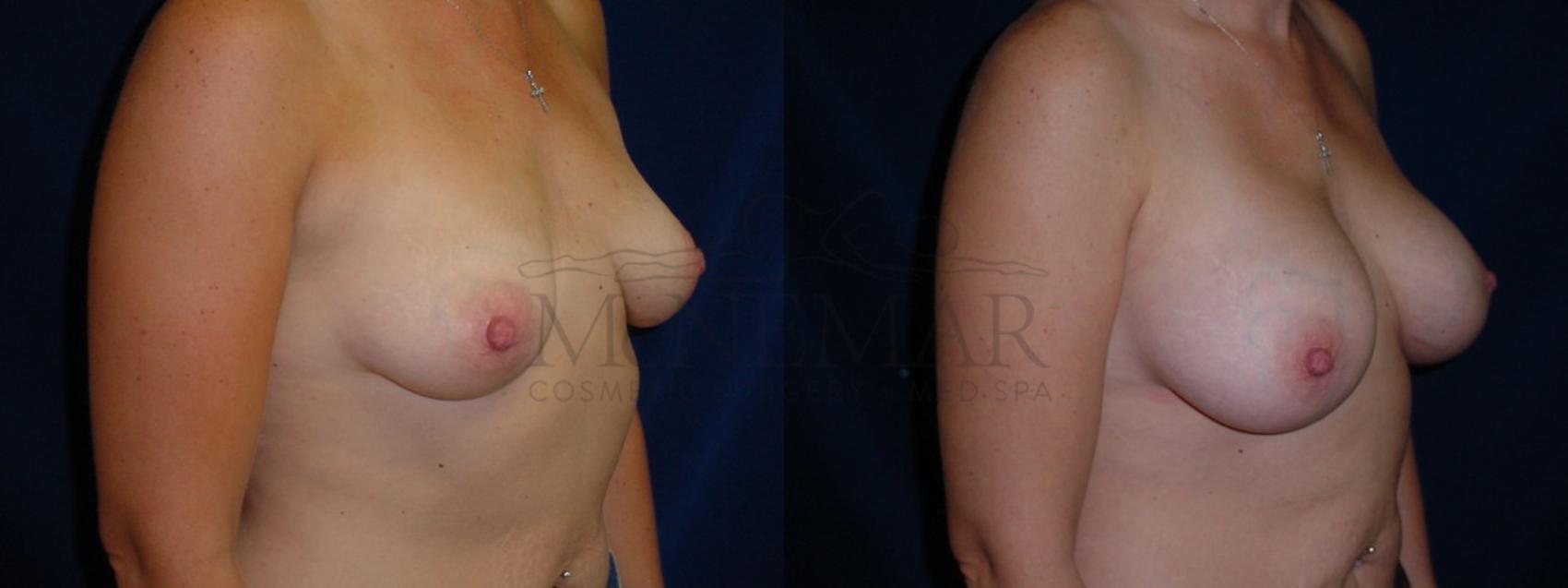 Breast Augmentation Case 27 Before & After View #2 | San Ramon & Tracy, CA | McNemar Cosmetic Surgery