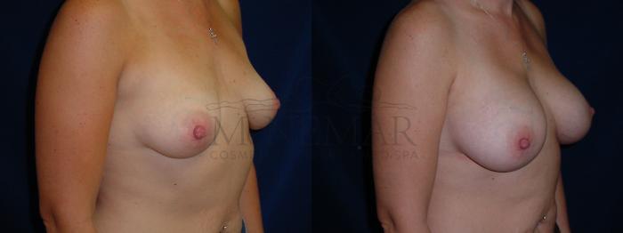Breast Augmentation Case 27 Before & After View #2 | Tracy, Brentwood & Livermore, CA | McNemar Cosmetic Surgery