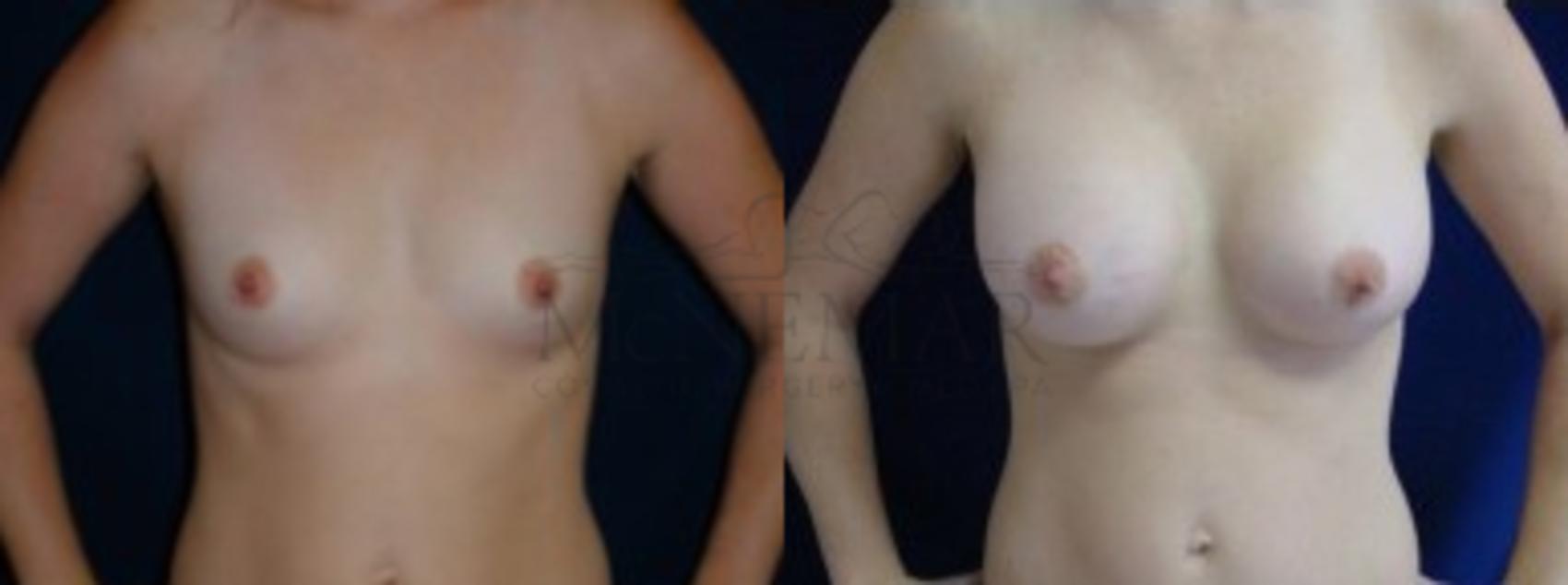 Breast Augmentation Case 3 Before & After View #1 | San Ramon & Tracy, CA | McNemar Cosmetic Surgery