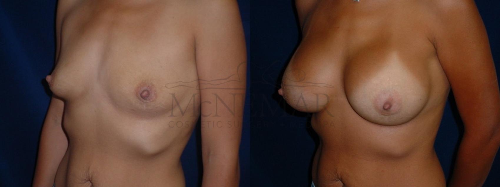 Breast Augmentation Case 37 Before & After View #2 | San Ramon & Tracy, CA | McNemar Cosmetic Surgery