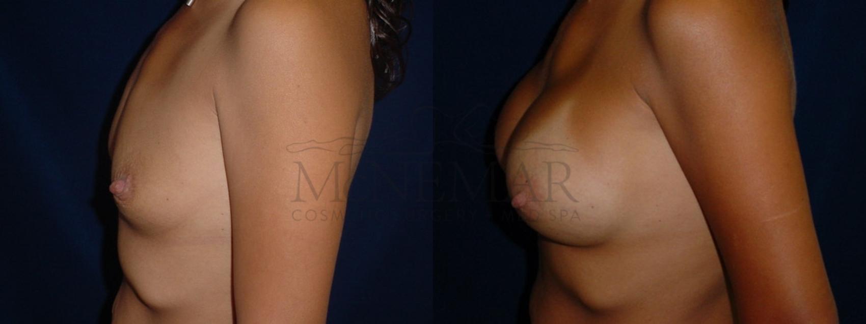 Breast Augmentation Case 37 Before & After View #3 | San Ramon & Tracy, CA | McNemar Cosmetic Surgery