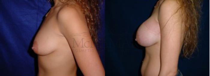 Breast Augmentation Case 4 Before & After View #2 | Tracy, Brentwood & Livermore, CA | McNemar Cosmetic Surgery