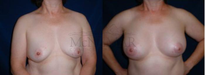 Breast Augmentation Case 5 Before & After View #1 | Tracy, Brentwood & Livermore, CA | McNemar Cosmetic Surgery