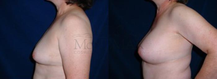 Breast Augmentation Case 5 Before & After View #2 | Tracy, Brentwood & Livermore, CA | McNemar Cosmetic Surgery
