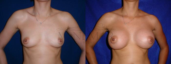 Breast Augmentation Case 59 Before & After View #1 | San Ramon & Tracy, CA | McNemar Cosmetic Surgery