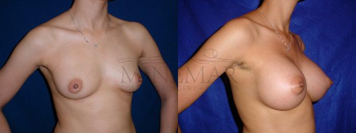 Breast Augmentation Case 59 Before & After View #2 | San Ramon & Tracy, CA | McNemar Cosmetic Surgery