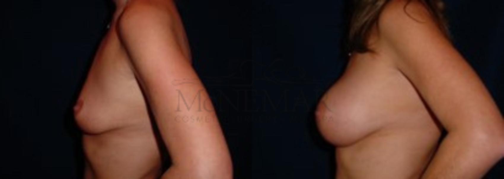 Breast Augmentation Case 6 Before & After View #2 | San Ramon & Tracy, CA | McNemar Cosmetic Surgery