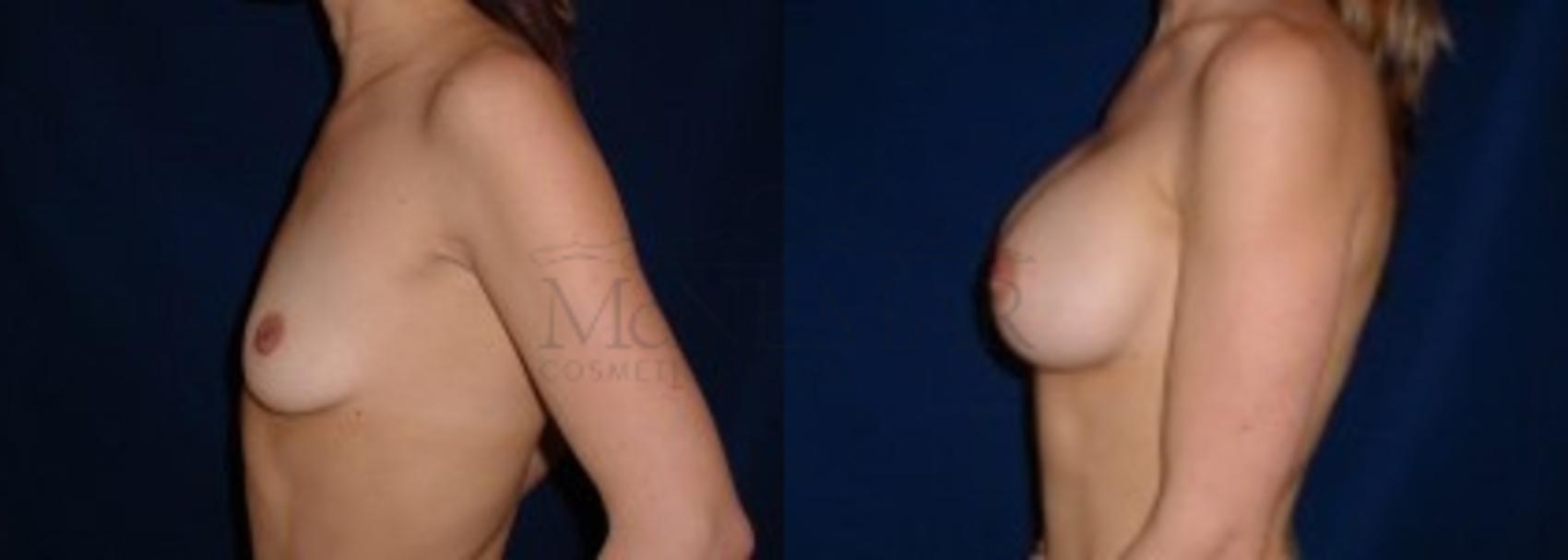Breast Augmentation Case 7 Before & After View #3 | San Ramon & Tracy, CA | McNemar Cosmetic Surgery