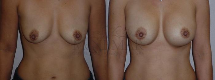 Breast Augmentation Case 76 Before & After View #1 | San Ramon & Tracy, CA | McNemar Cosmetic Surgery