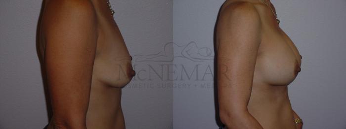 Breast Augmentation Case 76 Before & After View #3 | San Ramon & Tracy, CA | McNemar Cosmetic Surgery