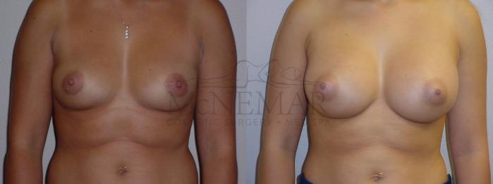 Breast Augmentation Case 81 Before & After View #1 | San Ramon & Tracy, CA | McNemar Cosmetic Surgery