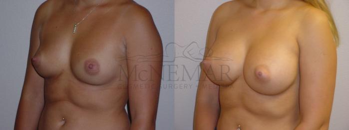 Breast Augmentation Case 81 Before & After View #2 | San Ramon & Tracy, CA | McNemar Cosmetic Surgery