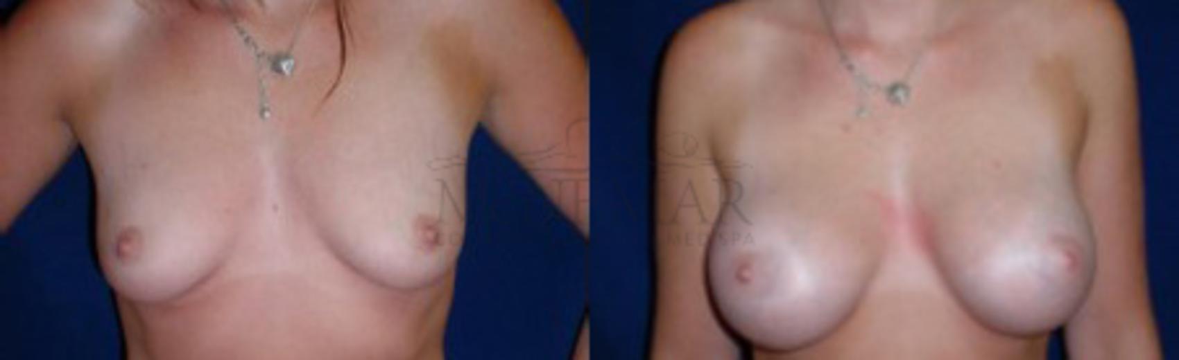 Breast Augmentation Case 9 Before & After View #1 | San Ramon & Tracy, CA | McNemar Cosmetic Surgery