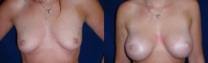 Breast Augmentation Case 9 Before & After View #1 | Tracy, Brentwood & Livermore, CA | McNemar Cosmetic Surgery