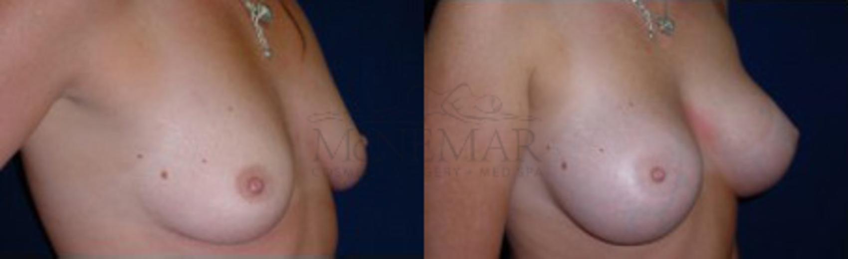 Breast Augmentation Case 9 Before & After View #2 | San Ramon & Tracy, CA | McNemar Cosmetic Surgery