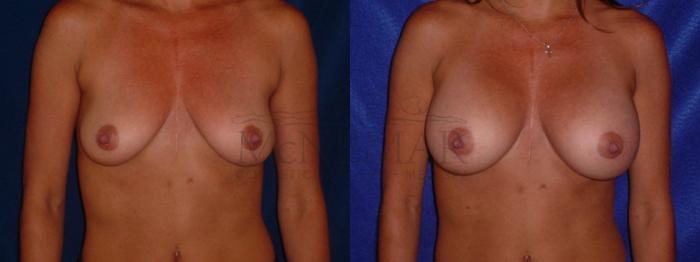 Breast Augmentation Case 91 Before & After View #1 | San Ramon & Tracy, CA | McNemar Cosmetic Surgery