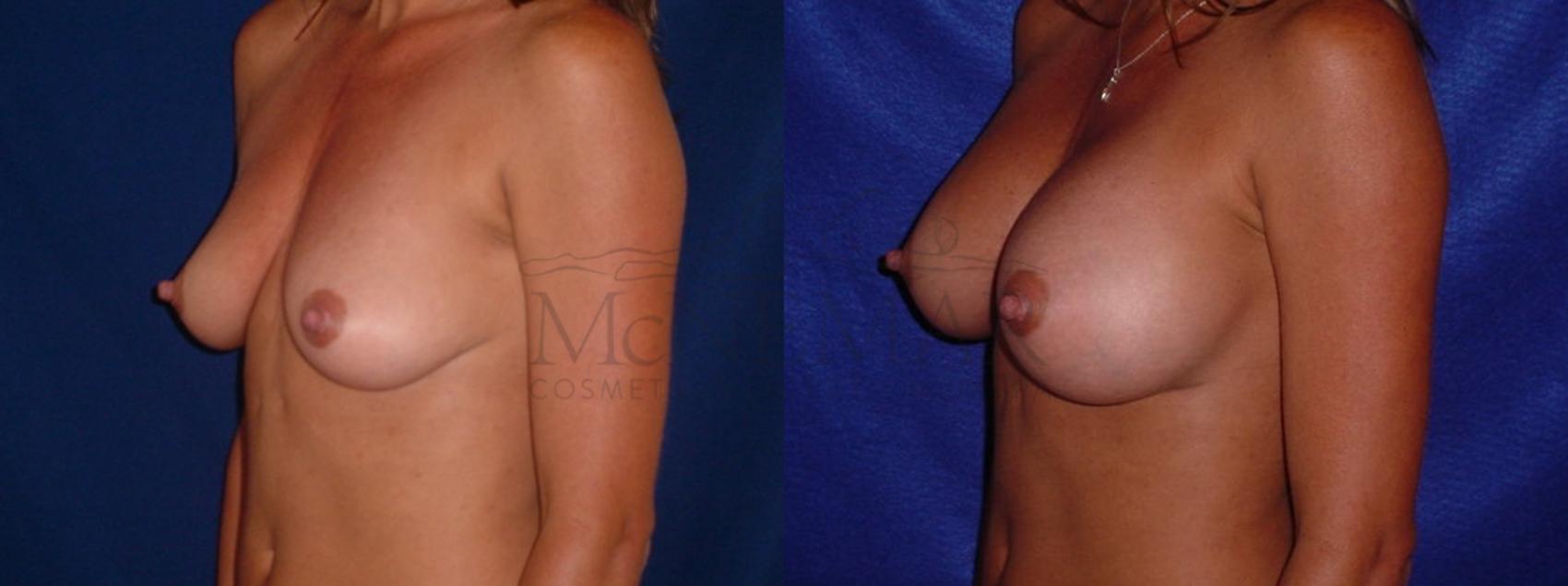 Breast Augmentation Case 91 Before & After View #2 | San Ramon & Tracy, CA | McNemar Cosmetic Surgery