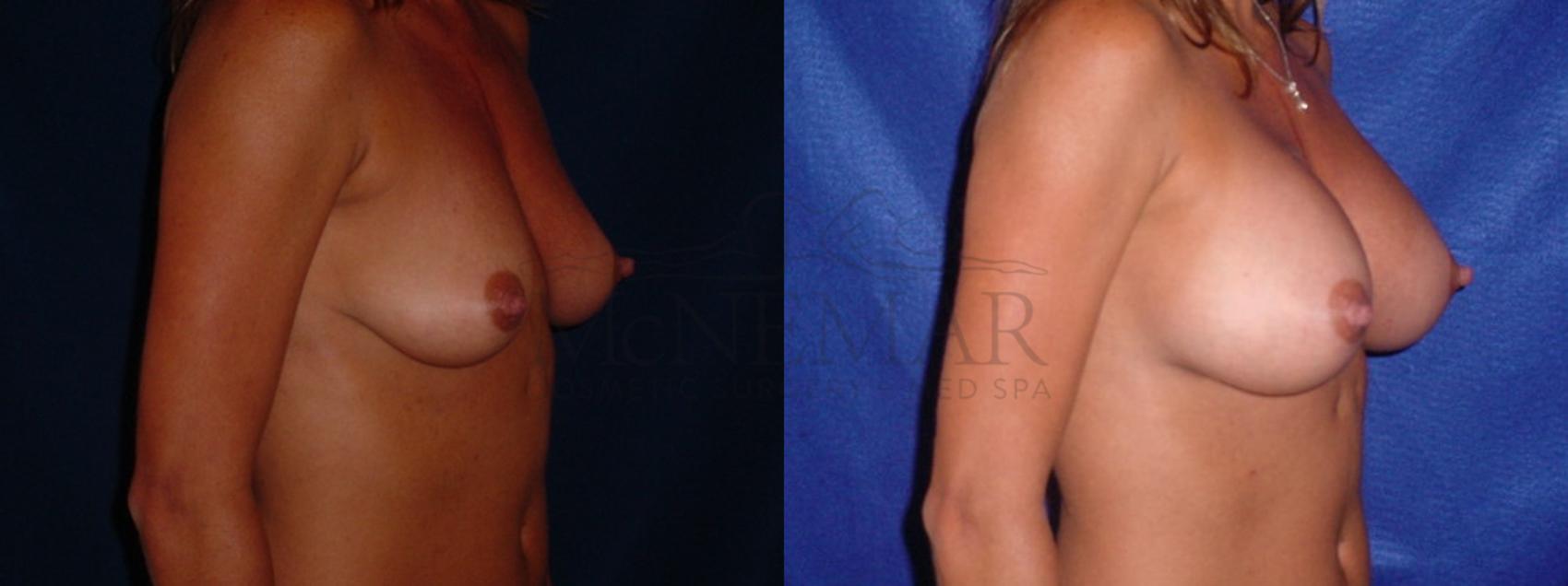Breast Augmentation Case 91 Before & After View #3 | San Ramon & Tracy, CA | McNemar Cosmetic Surgery