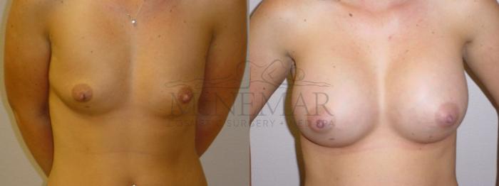 Breast Augmentation Case 92 Before & After View #1 | San Ramon & Tracy, CA | McNemar Cosmetic Surgery
