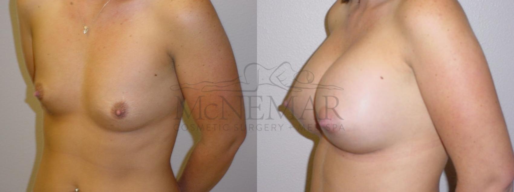 Breast Augmentation Case 92 Before & After View #2 | San Ramon & Tracy, CA | McNemar Cosmetic Surgery