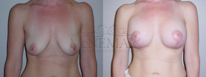 Breast Lift (Mastopexy) Case 100 Before & After View #1 | Tracy, Brentwood & Livermore, CA | McNemar Cosmetic Surgery