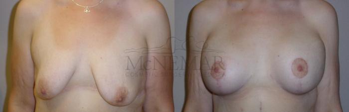 Breast Lift (Mastopexy) Case 106 Before & After View #1 | San Ramon & Tracy, CA | McNemar Cosmetic Surgery
