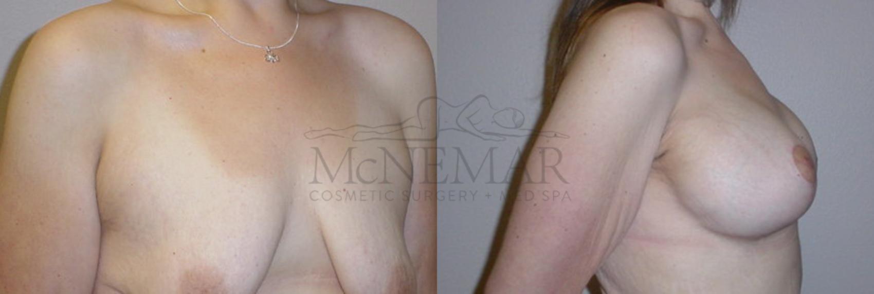 Breast Lift (Mastopexy) Case 106 Before & After View #2 | San Ramon & Tracy, CA | McNemar Cosmetic Surgery