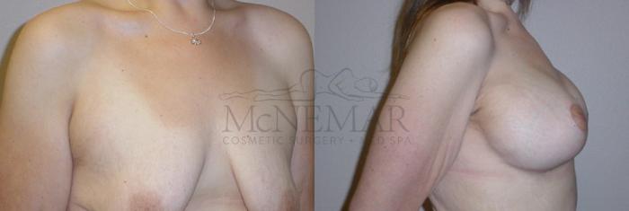 Breast Lift (Mastopexy) Case 106 Before & After View #2 | Tracy, Brentwood & Livermore, CA | McNemar Cosmetic Surgery