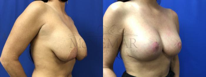 Breast Lift (Mastopexy) Case 141 Before & After Left Oblique | San Ramon & Tracy, CA | McNemar Cosmetic Surgery