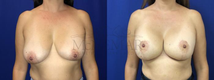 Breast Lift (Mastopexy) Case 148 Before & After Front | Tracy, Brentwood & Livermore, CA | McNemar Cosmetic Surgery