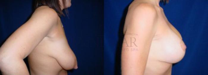 Breast Lift (Mastopexy) Case 16 Before & After View #2 | San Ramon & Tracy, CA | McNemar Cosmetic Surgery