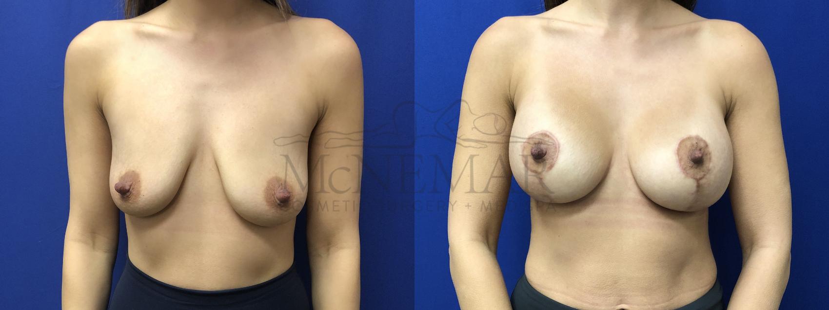 Breast Lift (Mastopexy) Case 185 Before & After Front | Tracy, Brentwood & Livermore, CA | McNemar Cosmetic Surgery