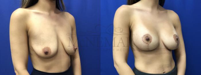 Breast Lift (Mastopexy) Case 185 Before & After Right Side | Tracy, Brentwood & Livermore, CA | McNemar Cosmetic Surgery