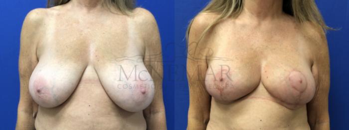 Breast Lift (Mastopexy) Case 199 Before & After Front | Tracy, Brentwood & Livermore, CA | McNemar Cosmetic Surgery