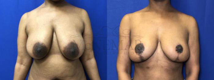 Breast Lift (Mastopexy) Case 201 Before & After Front | Tracy, Brentwood & Livermore, CA | McNemar Cosmetic Surgery