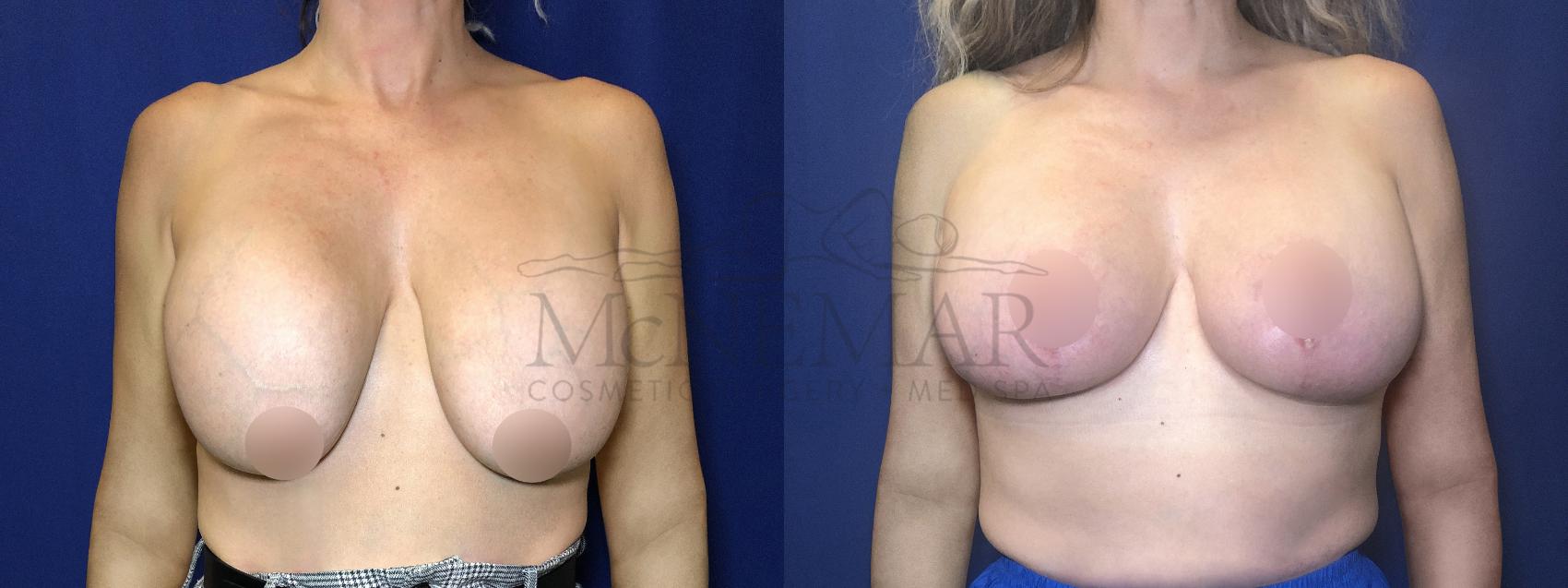 Breast Lift (Mastopexy) Case 207 Before & After Front | Tracy, Brentwood & Livermore, CA | McNemar Cosmetic Surgery